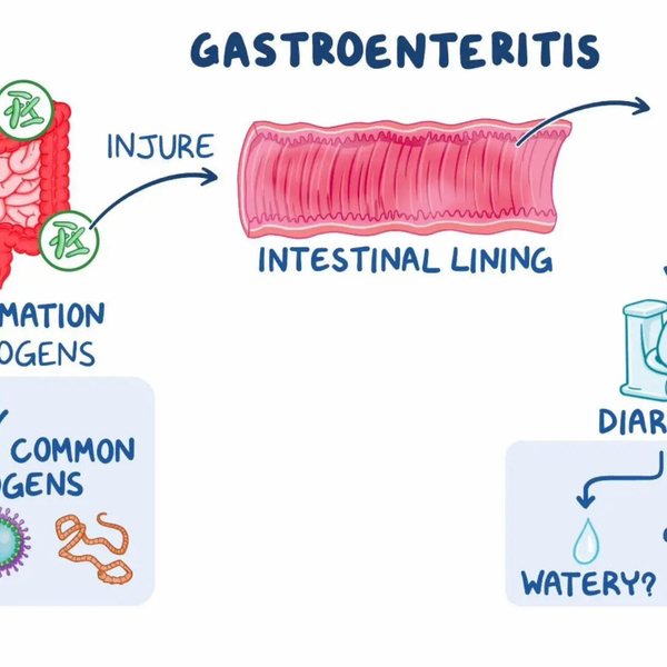 Health Ministry Confirms Increase in Gastroenteritis Linked to Norovirus artwork